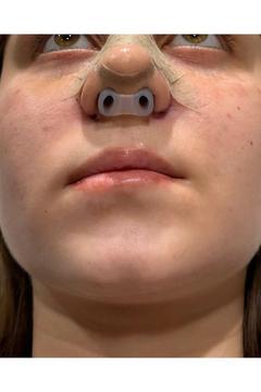 footlıne foot healthly Burun Deliği Şekillendirici(1)(7)nostril Retainer